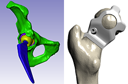 Partner news: Simpleware and Corin developing personalised hip replacements